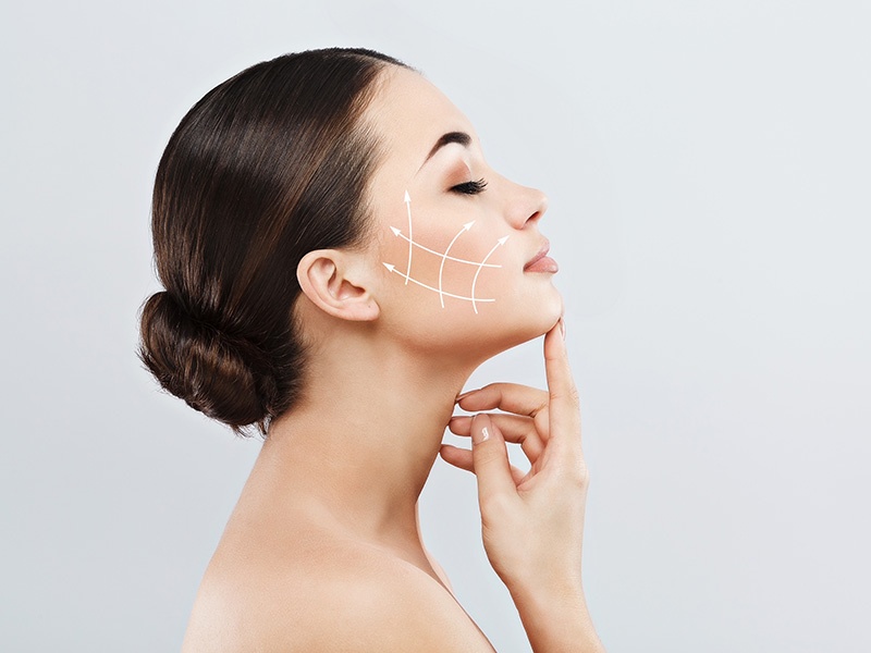Profhilo model showing her face and shoulders